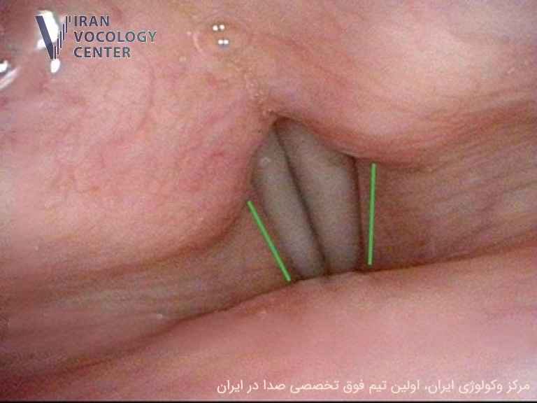 اختلال صوتی اسپاسمودیک (SD)، دیستونی حنجره
