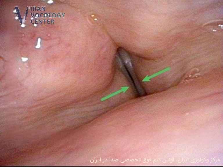 دیسفونی ناشی از اسپاسم (SD)، اختلال حرکتی حنجره
