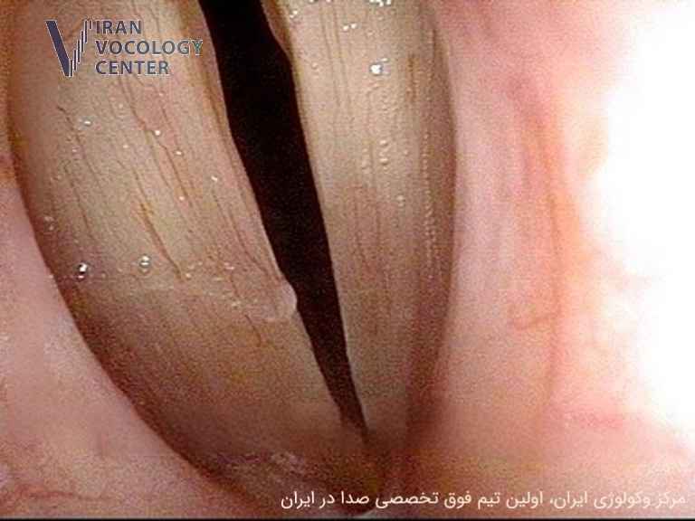 اسپاسمودیک دیسفونی (SD)، دیستونی حنجرهای