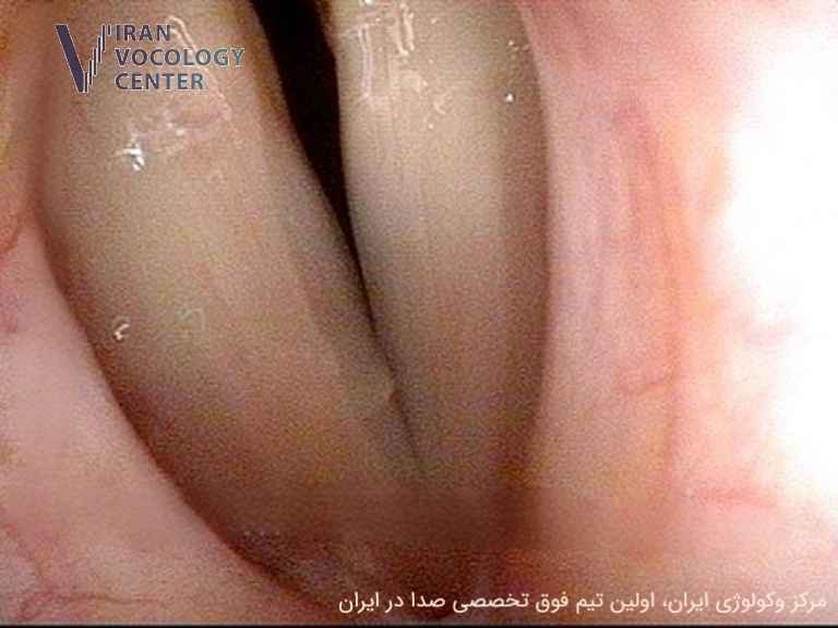 اختلال دیسفونی اسپاسمودیک (SD)، دیستونی عضلانی حنجره