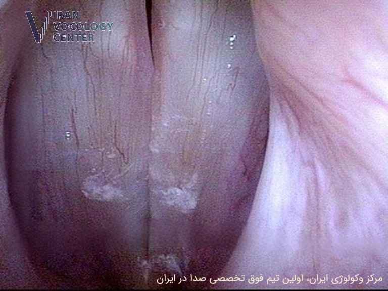 دیسفونی ناشی از اسپاسم حنجره (SD)، اختلال حرکتی صدا