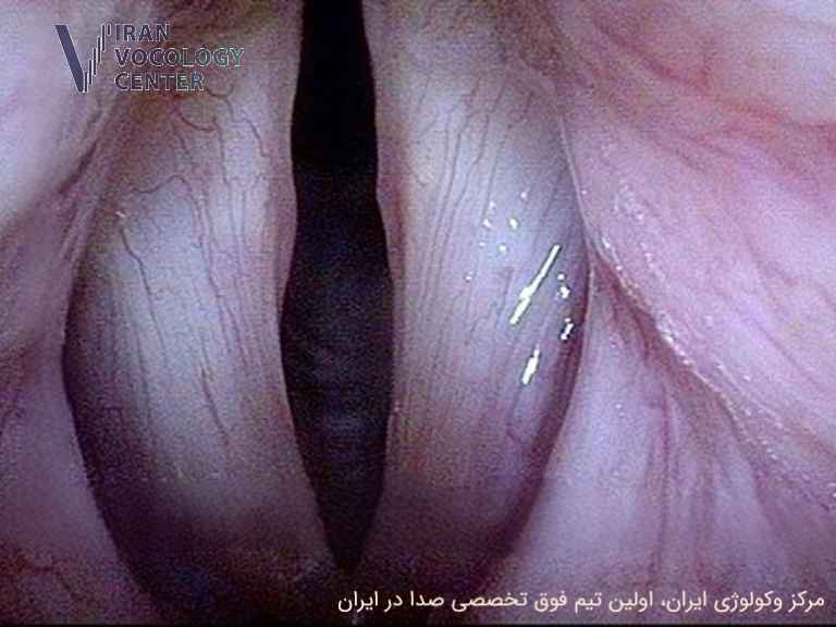 اسپاسم حنجرهای (SD)، دیستونی صدا