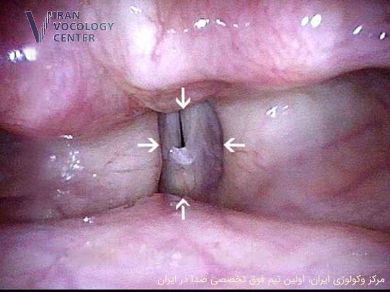 دیسفونی اسپاسمودیک (SD)، اختلال حرکتی حنجرهای