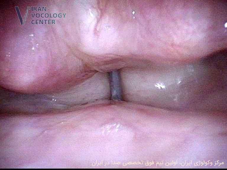 اختلال اسپاسمودیک حنجره (SD)، دیستونی صوتی
